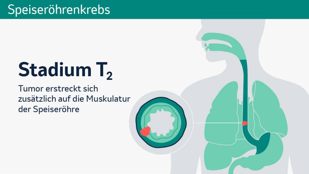 Speiseröhrenkrebs: Schematische Darstellung der verschiedenen Tumorstadien in einem Querschnitt.