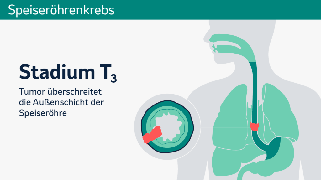 Speiseröhrenkrebs: Schematische Darstellung der verschiedenen Tumorstadien in einem Querschnitt.