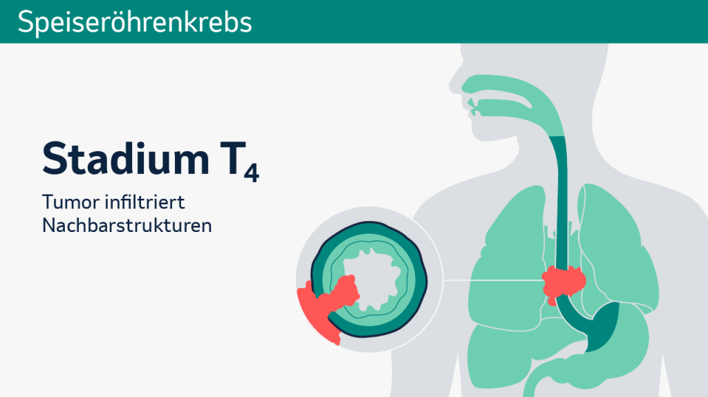 Speiseröhrenkrebs: Schematische Darstellung der verschiedenen Tumorstadien in einem Querschnitt.