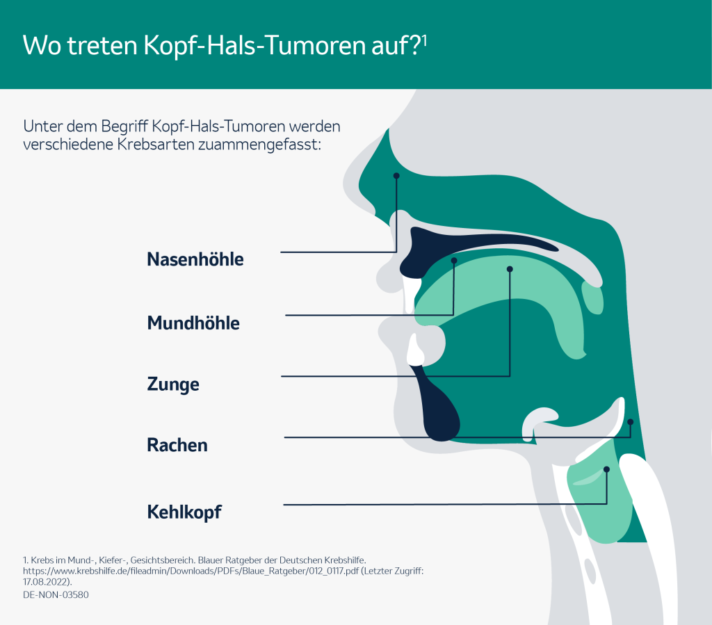 Infografik: Krebs an Kopf und Hals: Wo treten Kopf-Hals-Tumoren auf?