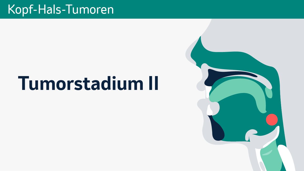 Kopf-Hals-Krebs, Tumorstadium II