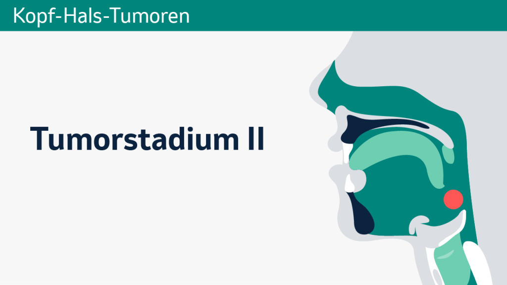 Kopf-Hals-Krebs, Tumorstadium II