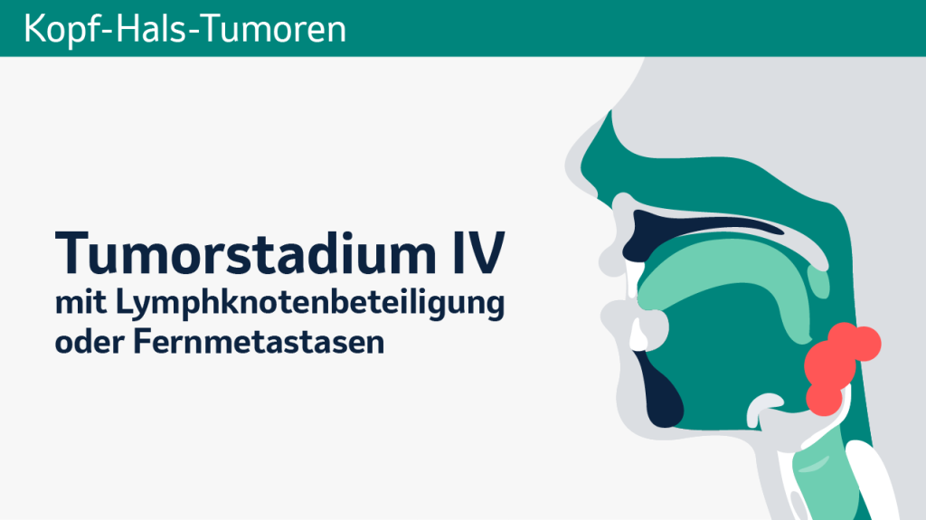 Kopf-Hals-Krebs, Tumorstadium IV