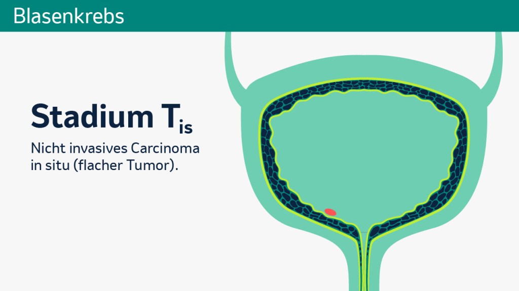 Stadieneinteilung des Primärtumors der Blase. 
