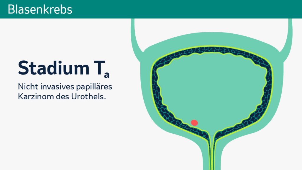 Stadieneinteilung des Primärtumors der Blase. 
