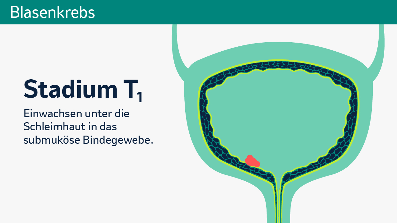 Stadieneinteilung des Primärtumors der Blase. 
