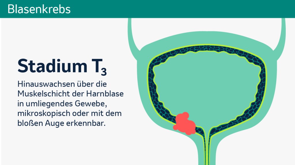 Stadieneinteilung des Primärtumors der Blase. 