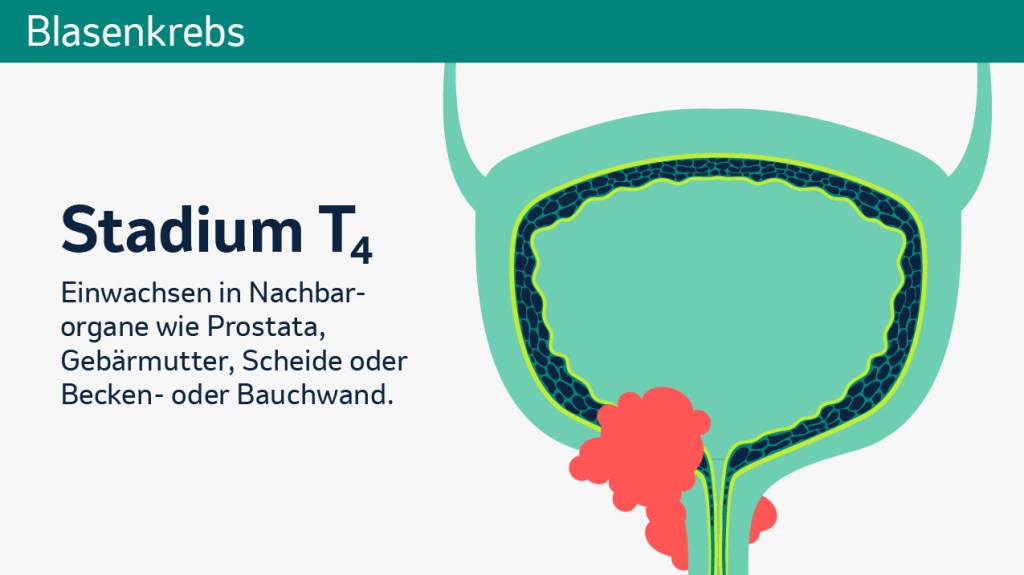 Stadieneinteilung des Primärtumors der Blase. 