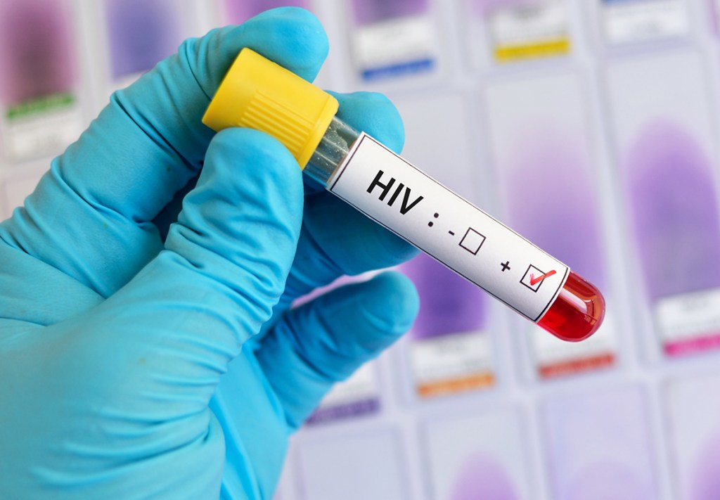 Beispiel für einen Blut-basierten HIV-Test (HIV-Labortest)