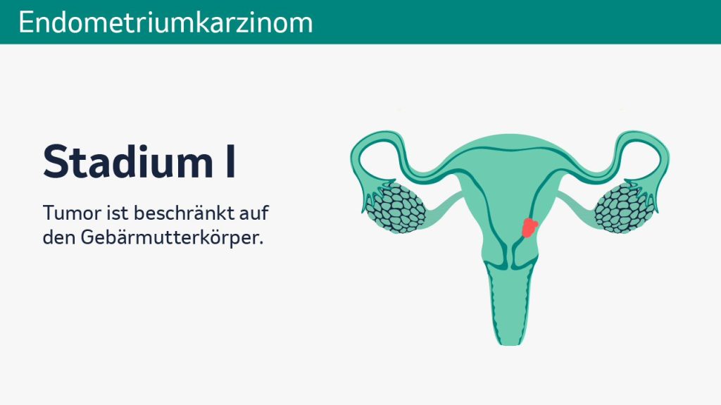 Endometriumkarzinom Grafik 1
