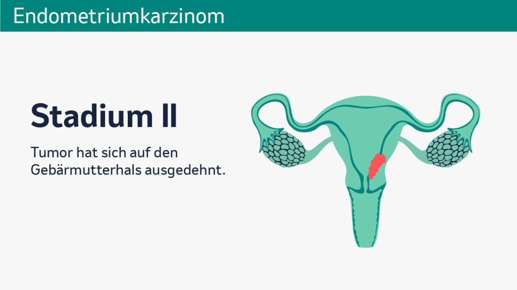 Endometriumkarzinom Grafik 2