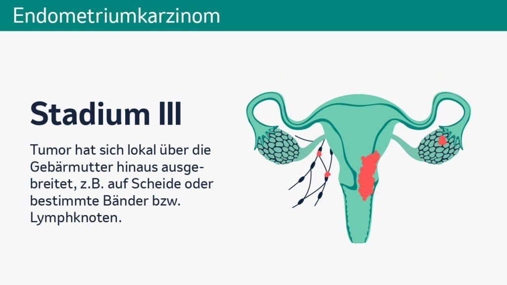 Endometriumkarzinom Grafik 3