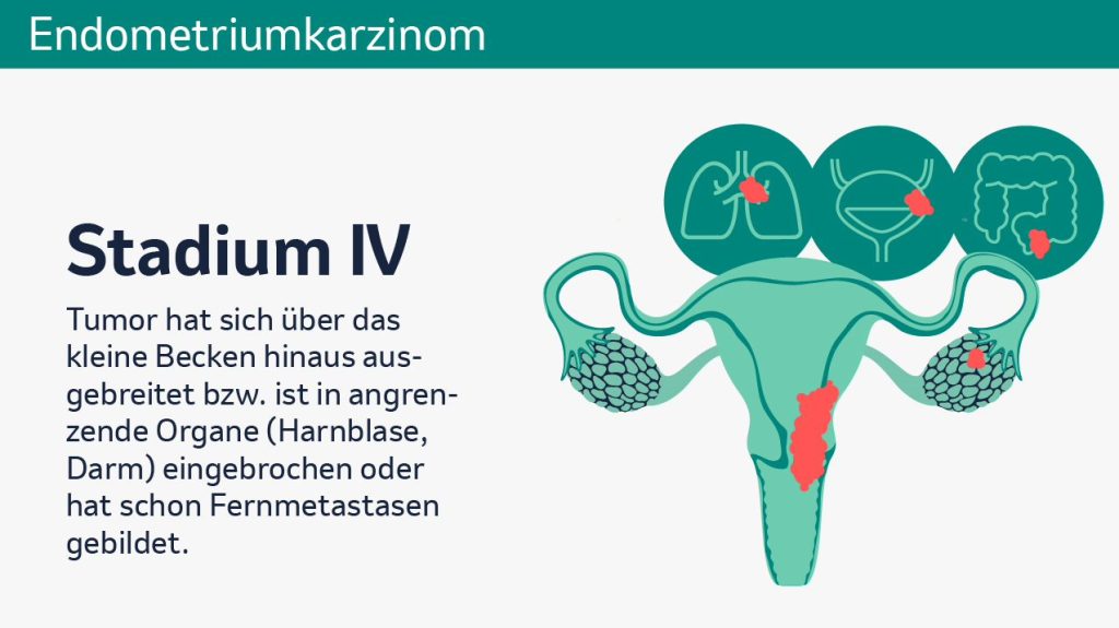 Endometriumkarzinom Grafik 4