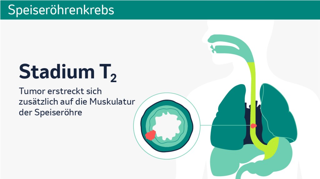 Speiseröhrenkrebs: Schematische Darstellung der verschiedenen Tumorstadien in einem Querschnitt. 