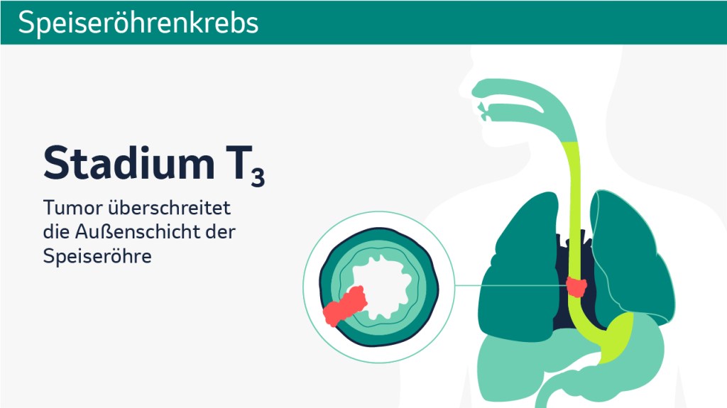 Speiseröhrenkrebs: Schematische Darstellung der verschiedenen Tumorstadien in einem Querschnitt. 