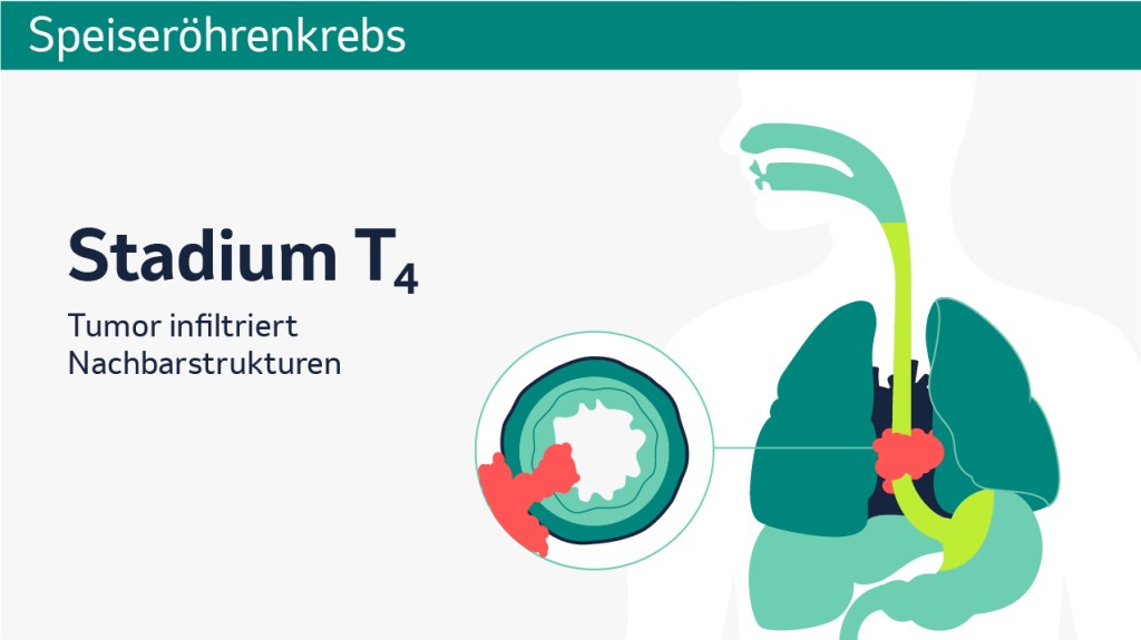 Speiseröhrenkrebs: Schematische Darstellung der verschiedenen Tumorstadien in einem Querschnitt. 