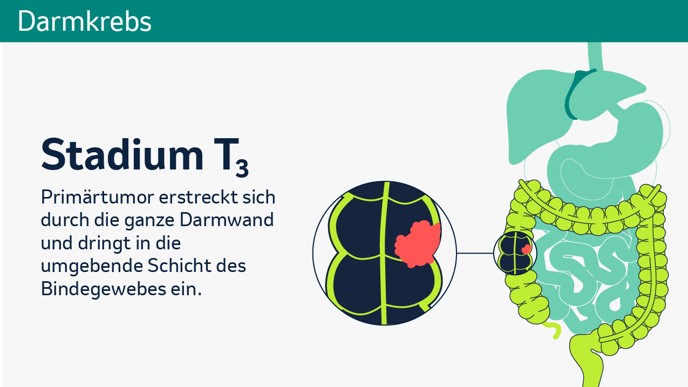 Darmkrebs Bild 5