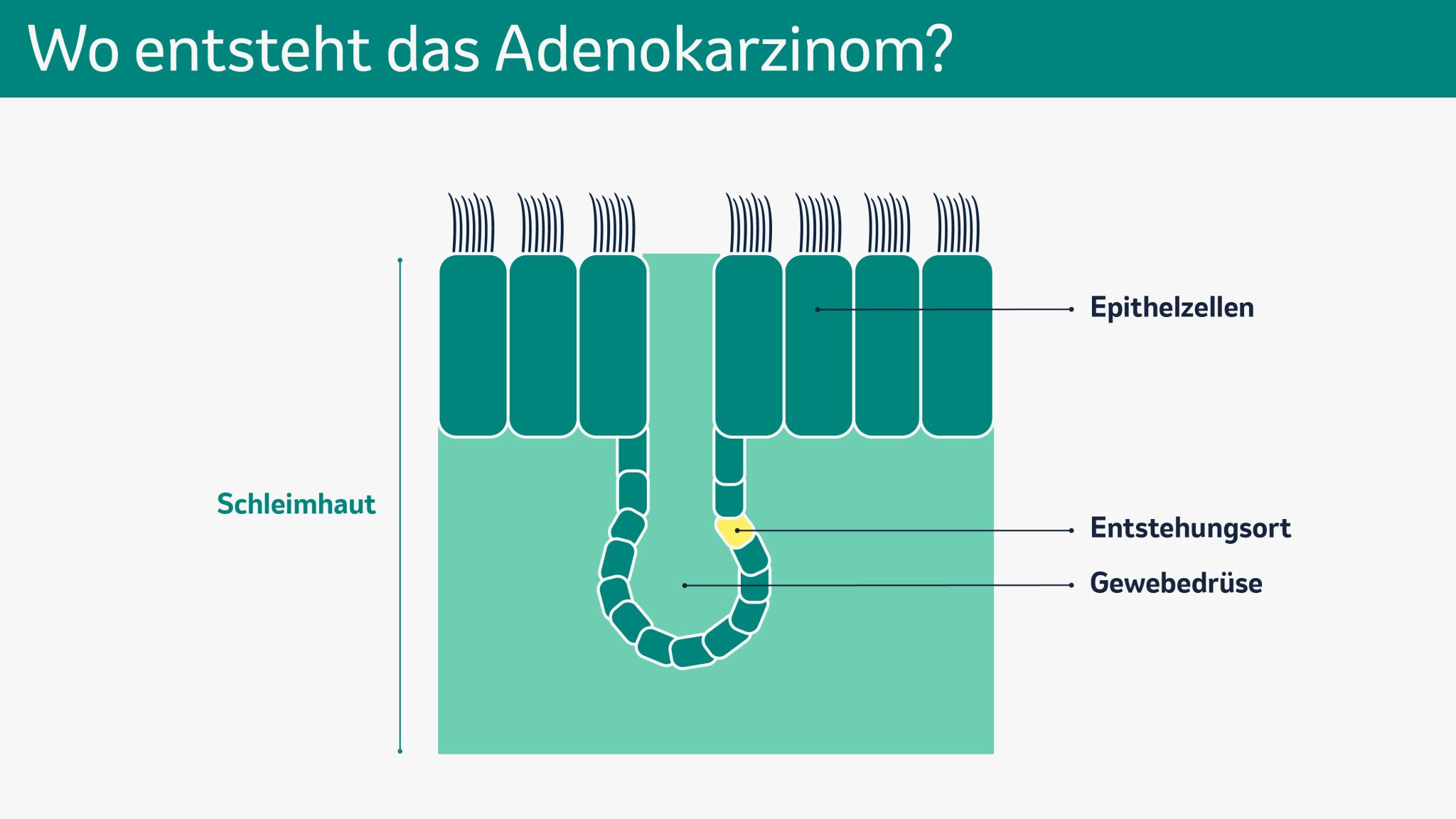 Die Abbildung zeigt eine schematische Darstellung von Epithelzellen und Gewebedrüsen in der Lunge und den Entstehungsort einer möglichen entarteten Veränderung.