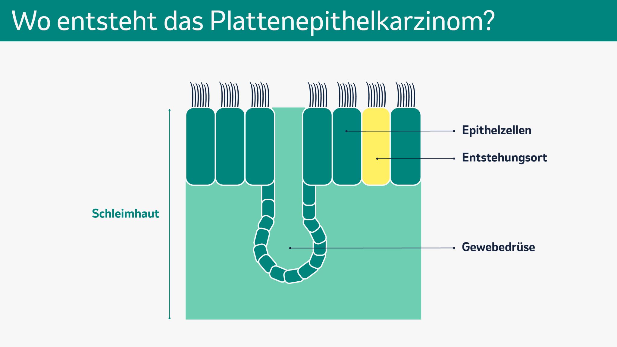 Die Abbildung zeigt eine schematische Darstellung von Veränderungen der Atemwegsschleimhaut (mit Epithelzellen und Gewebedrüsen) durch schädliche Einflüsse.