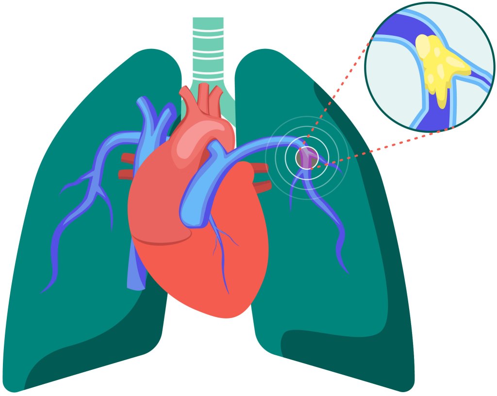Schematische Darstellung des Herzens und der großen Arterien in der Lunge. In der Nahaufnahme ist ein Blutgerinnsel in einem der Gefäße zu erkennen.