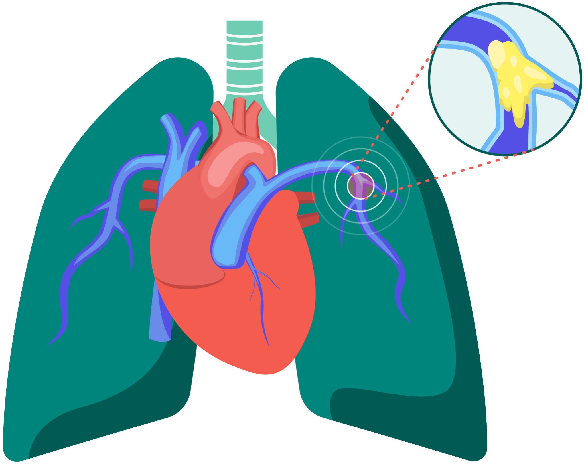 Schematische Darstellung des Herzens und der großen Arterien in der Lunge. In der Nahaufnahme ist ein Blutgerinnsel in einem der Gefäße zu erkennen.