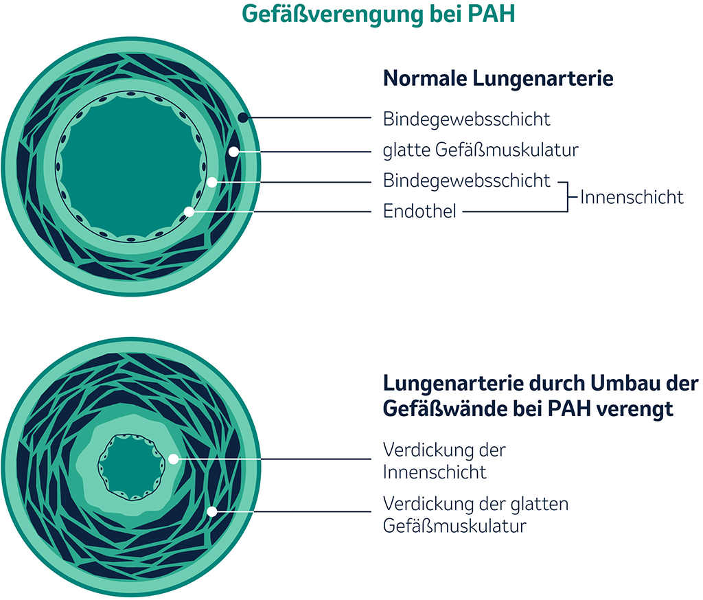 Schematische Darstellung einer Gefäßverengung bei PAH