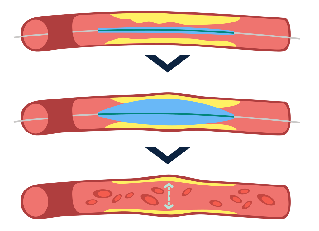 Schematische Darstellung der Ballonangioplastie in drei Zuständen: Verengte Pulmonalarterie, Pulmonalarterie mit Ballon, aufgeweitete Pulmonalarterie