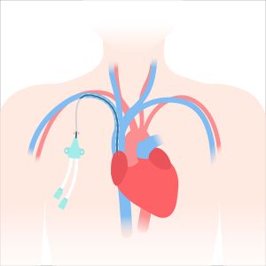 Illustration einer Rechtsherzkatheter-Untersuchung