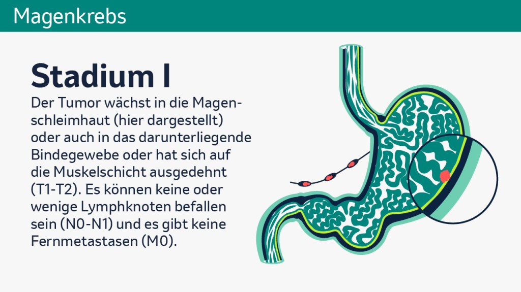 Die Grafik zeigt einen beispielhaften Magenquerschnitt bei Magenkrebs im Stadium 1. Daneben steht der Text „Der Tumor wächst in die Magenschleimhaut (hier dargestellt) oder auch in das darunterliegende Bindegewebe oder hat sich auf die Muskelschicht ausgedehnt (T1-T2). Es können keine oder wenige Lymphknoten befallen sein (N0-N1) und es gibt keine Fernmetastasen (M0). 