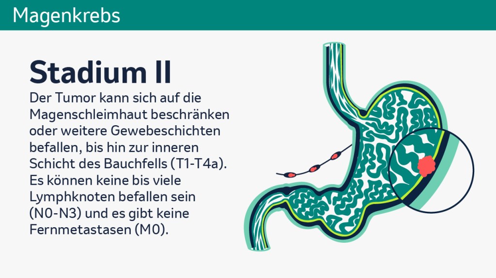 Die Grafik zeigt einen beispielhaften Magenquerschnitt bei Magenkrebs im Stadium 2. Daneben steht der Text „Der Tumor kann sich auf die Magenschleimhaut beschränken oder weitere Gewebeschichten befallen, bis hin zur inneren Schicht des Bauchfells (T1-T4a). Es können keine bis viele Lymphknoten befallen sein (N0-N3) und es gibt keine Fernmetastasen (M0).“