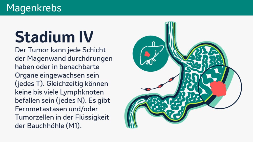 Die Grafik zeigt einen beispielhaften Magenquerschnitt bei Magenkrebs im Stadium 4. Daneben steht der Text „Der Tumor kann jede Schicht der Magenwand durchdrungen haben oder in benachbarte Organe eingewachsen sein (jedes T). Gleichzeitig können keine bis viele Lymphknoten befallen sein (jedes N). Es gibt Fernmetastasen und/oder Tumorzellen in der Flüssigkeit der Bauchhöhle (M1). 