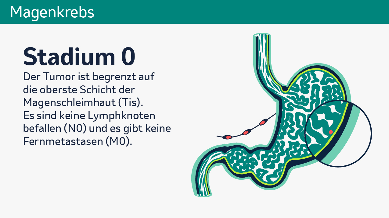 Die Grafik zeigt einen beispielhaften Magenquerschnitt bei Magenkrebs im Stadium 0. Daneben steht der Text „Der Tumor ist begrenzt auf die oberste Schicht der Magenschleimhaut (Tis). Es sind keine Lymphknoten befallen (N0) und es gibt keine Fernmetastasen (M0). 