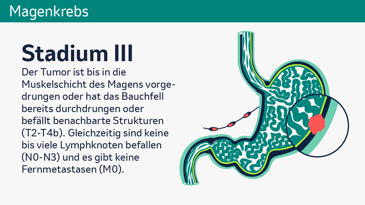 Die Grafik zeigt einen beispielhaften Magenquerschnitt bei Magenkrebs im Stadium 3. Daneben steht der Text „Der Tumor ist bis in die Muskelschicht des Magens vorgedrungen oder hat das Bauchfell bereits durchdrungen oder befällt benachbarte Strukturen (T2-T4b). Gleichzeitig sind keine bis viele Lymphknoten befallen (N0-N3) und es gibt keine Fernmetastasen (M0). 