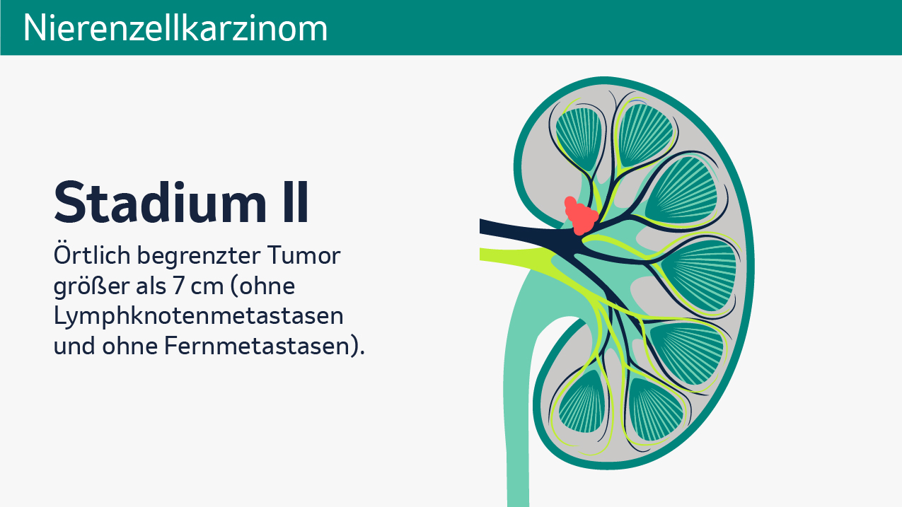 Vier Abbildungen zeigen unterschiedliche Stadien von Nierenkrebs, Stadien I bis IV. Jede der Abbildungen zeigt eine schematische Darstellung einer menschlichen Niere im Querschnitt. Zu sehen sind die Nierenkapsel, Nierenpyramiden, Nierenrinde, Nierenkelche, Nierenarterie, Nierenvene, Nierenbecken und der Harnleiter. Die verschiedenen Bereiche sind farblich voneinander abgehoben, um ihre Funktionen visuell zu verdeutlichen. Stadium I zeigt einen auf die Niere begrenzten Tumor bis zu einer Größe von 7cm, welcher in roter Farbe am Nierenkelch eingezeichnet ist. Stadium II zeigt einen örtlich begrenzten Tumor größer als 7cm (ohne Lymphknotenmetastasen und ohne Fernknotenmetastasen), welcher in roter Farbe, etwas größer als im vorherigen Stadium, am Nierenkelch eingezeichnet ist. Stadium III zeigt einen kleinen Tumor mit Lymphknotenmetastasen sowie einen großen Tumor (mit oder ohne Lymphknotenmetastasen), welche an Nierenkelch und Nierenvene eingezeichnet sind (beide ohne Fernmetastasen). Stadium IV zeigt dieselben Tumoren mit Fernmetastasen, welche am Beispiel eines Gehirns gezeigt werden, unabhängig von der Größe. Stadium IV kann auch einen Tumor beschreiben, der über die Fettkapsel der Niere gewachsen ist oder in die Nebenniere eindringt. 