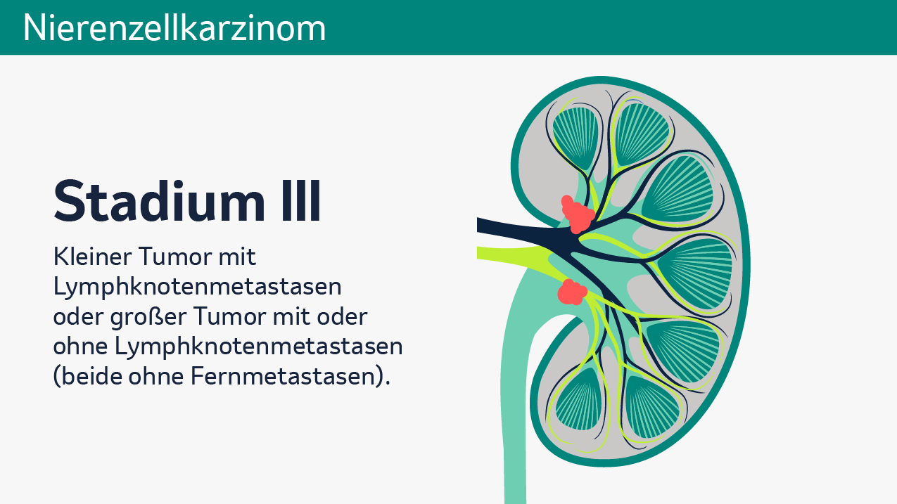 Vier Abbildungen zeigen unterschiedliche Stadien von Nierenkrebs, Stadien I bis IV. Jede der Abbildungen zeigt eine schematische Darstellung einer menschlichen Niere im Querschnitt. Zu sehen sind die Nierenkapsel, Nierenpyramiden, Nierenrinde, Nierenkelche, Nierenarterie, Nierenvene, Nierenbecken und der Harnleiter. Die verschiedenen Bereiche sind farblich voneinander abgehoben, um ihre Funktionen visuell zu verdeutlichen. Stadium I zeigt einen auf die Niere begrenzten Tumor bis zu einer Größe von 7cm, welcher in roter Farbe am Nierenkelch eingezeichnet ist. Stadium II zeigt einen örtlich begrenzten Tumor größer als 7cm (ohne Lymphknotenmetastasen und ohne Fernknotenmetastasen), welcher in roter Farbe, etwas größer als im vorherigen Stadium, am Nierenkelch eingezeichnet ist. Stadium III zeigt einen kleinen Tumor mit Lymphknotenmetastasen sowie einen großen Tumor (mit oder ohne Lymphknotenmetastasen), welche an Nierenkelch und Nierenvene eingezeichnet sind (beide ohne Fernmetastasen). Stadium IV zeigt dieselben Tumoren mit Fernmetastasen, welche am Beispiel eines Gehirns gezeigt werden, unabhängig von der Größe. Stadium IV kann auch einen Tumor beschreiben, der über die Fettkapsel der Niere gewachsen ist oder in die Nebenniere eindringt. 