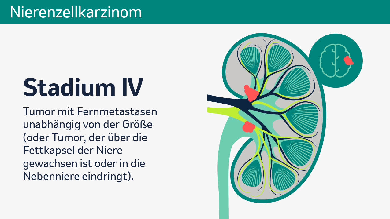 Vier Abbildungen zeigen unterschiedliche Stadien von Nierenkrebs, Stadien I bis IV. Jede der Abbildungen zeigt eine schematische Darstellung einer menschlichen Niere im Querschnitt. Zu sehen sind die Nierenkapsel, Nierenpyramiden, Nierenrinde, Nierenkelche, Nierenarterie, Nierenvene, Nierenbecken und der Harnleiter. Die verschiedenen Bereiche sind farblich voneinander abgehoben, um ihre Funktionen visuell zu verdeutlichen. Stadium I zeigt einen auf die Niere begrenzten Tumor bis zu einer Größe von 7cm, welcher in roter Farbe am Nierenkelch eingezeichnet ist. Stadium II zeigt einen örtlich begrenzten Tumor größer als 7cm (ohne Lymphknotenmetastasen und ohne Fernknotenmetastasen), welcher in roter Farbe, etwas größer als im vorherigen Stadium, am Nierenkelch eingezeichnet ist. Stadium III zeigt einen kleinen Tumor mit Lymphknotenmetastasen sowie einen großen Tumor (mit oder ohne Lymphknotenmetastasen), welche an Nierenkelch und Nierenvene eingezeichnet sind (beide ohne Fernmetastasen). Stadium IV zeigt dieselben Tumoren mit Fernmetastasen, welche am Beispiel eines Gehirns gezeigt werden, unabhängig von der Größe. Stadium IV kann auch einen Tumor beschreiben, der über die Fettkapsel der Niere gewachsen ist oder in die Nebenniere eindringt. 
