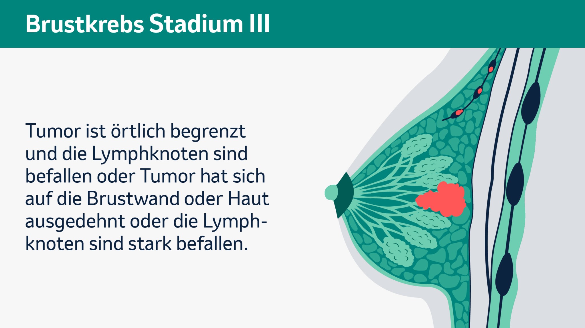 Brustkrebs Stadium III
