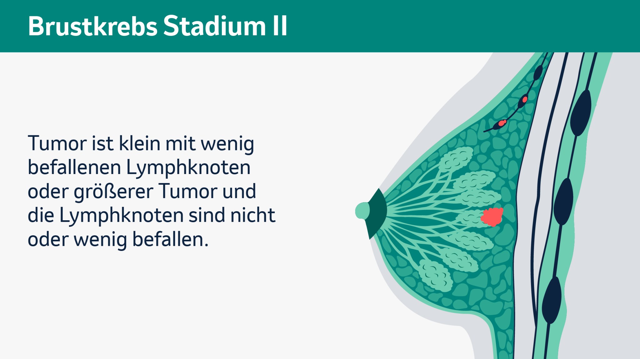 Brustkrebs Stadium II