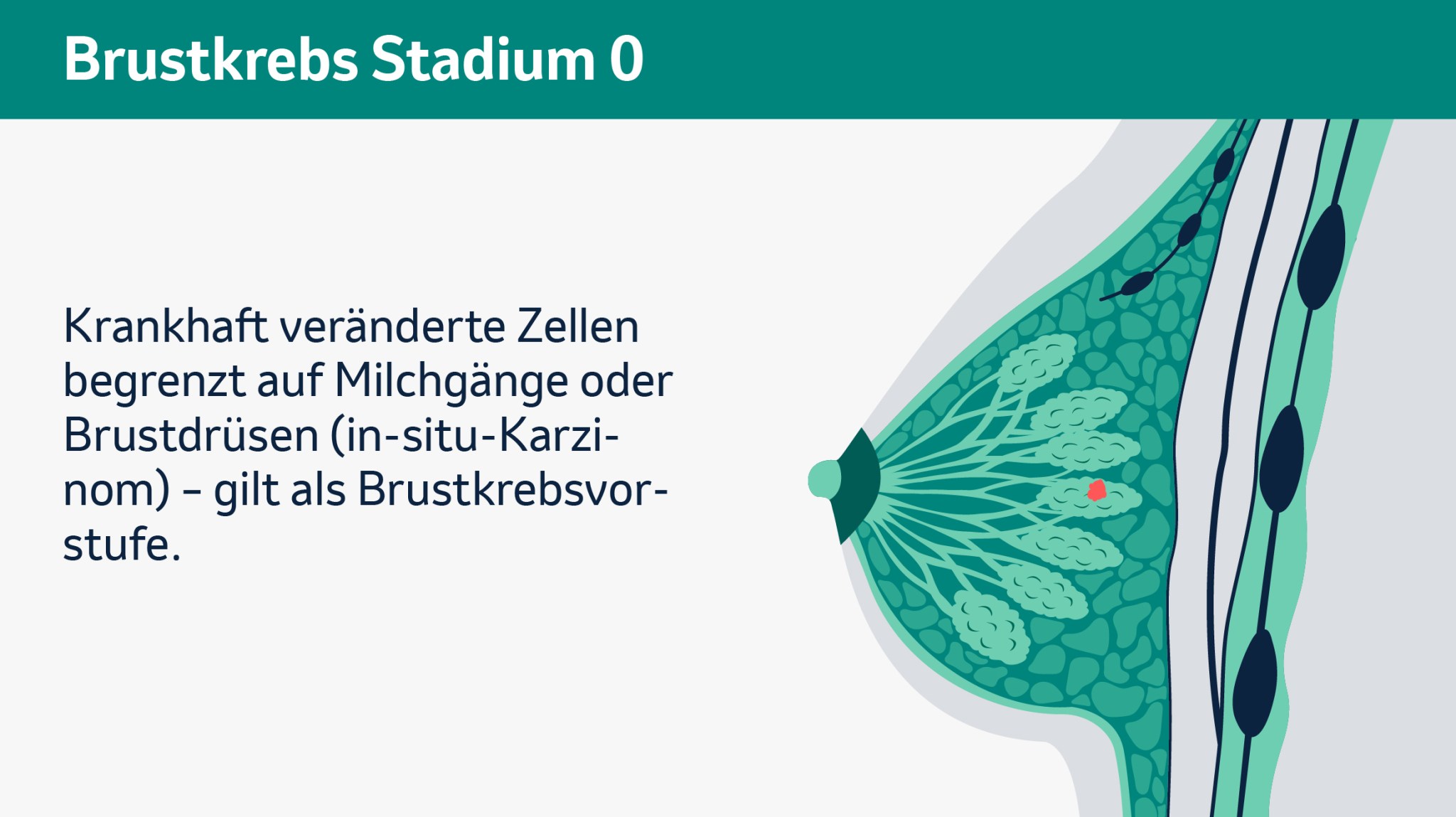 Brustkrebs Stadium 0