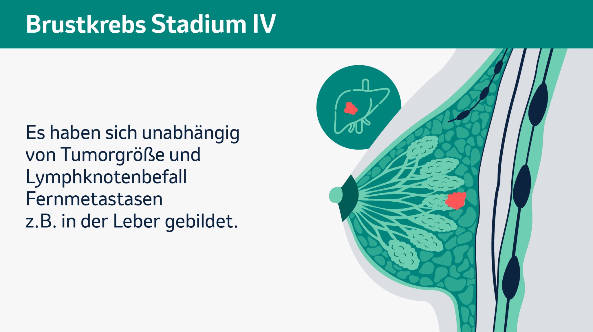 Brustkrebs Stadium IV