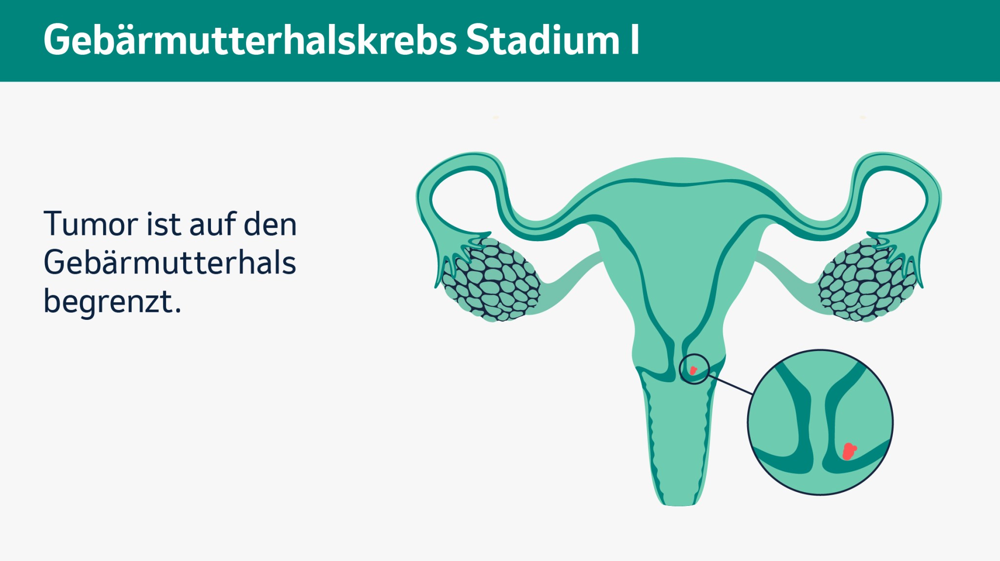 Schematische Darstellung der Gebärmutter mit einem auf den Gebärmutterhals begrenzten Tumor (Stadium I).