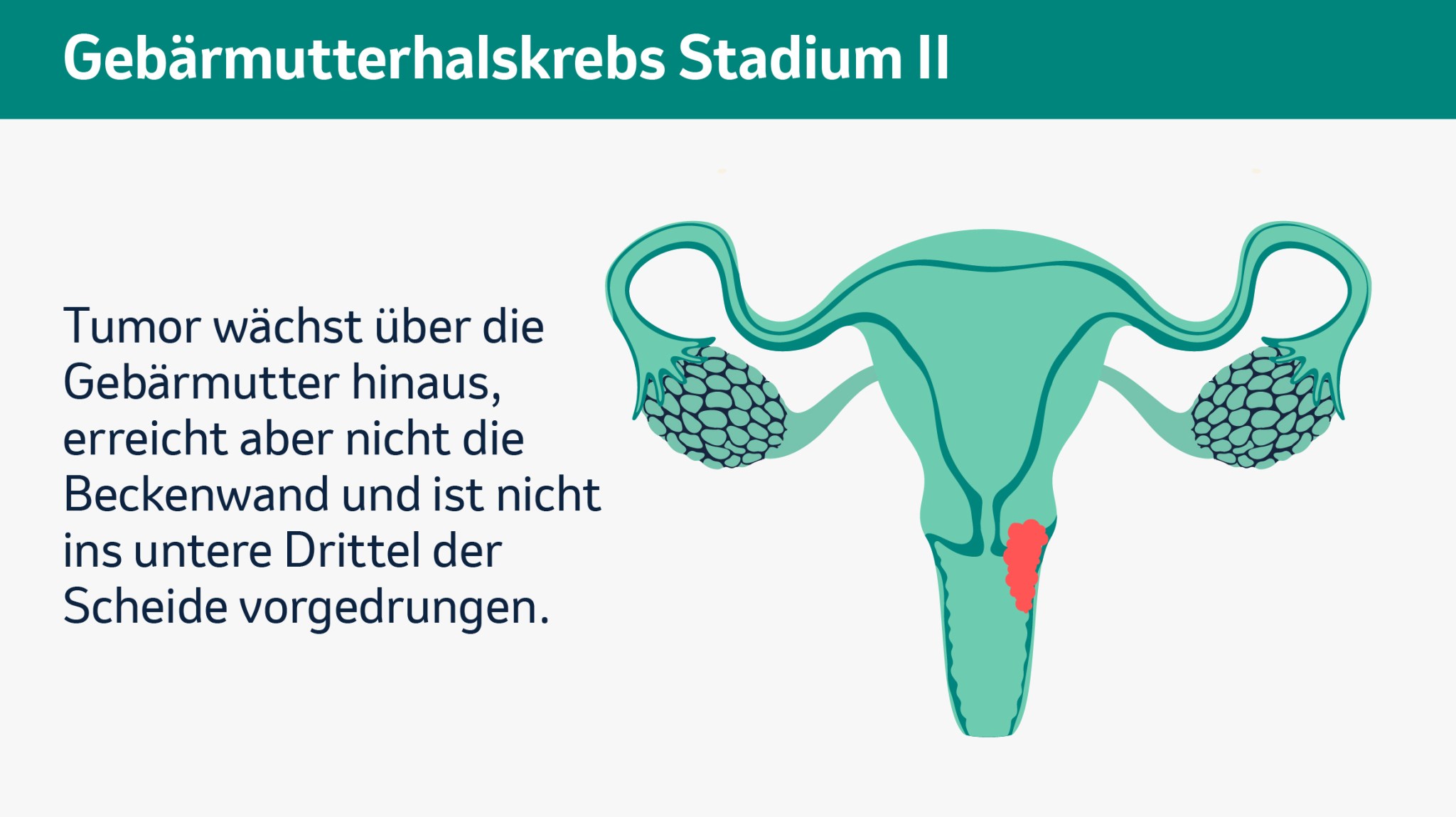 Schematische Darstellung der Gebärmutter mit Tumor, der über den Gebärmutterhals hinaus in umliegendes Gewebe wächst (Stadium II).