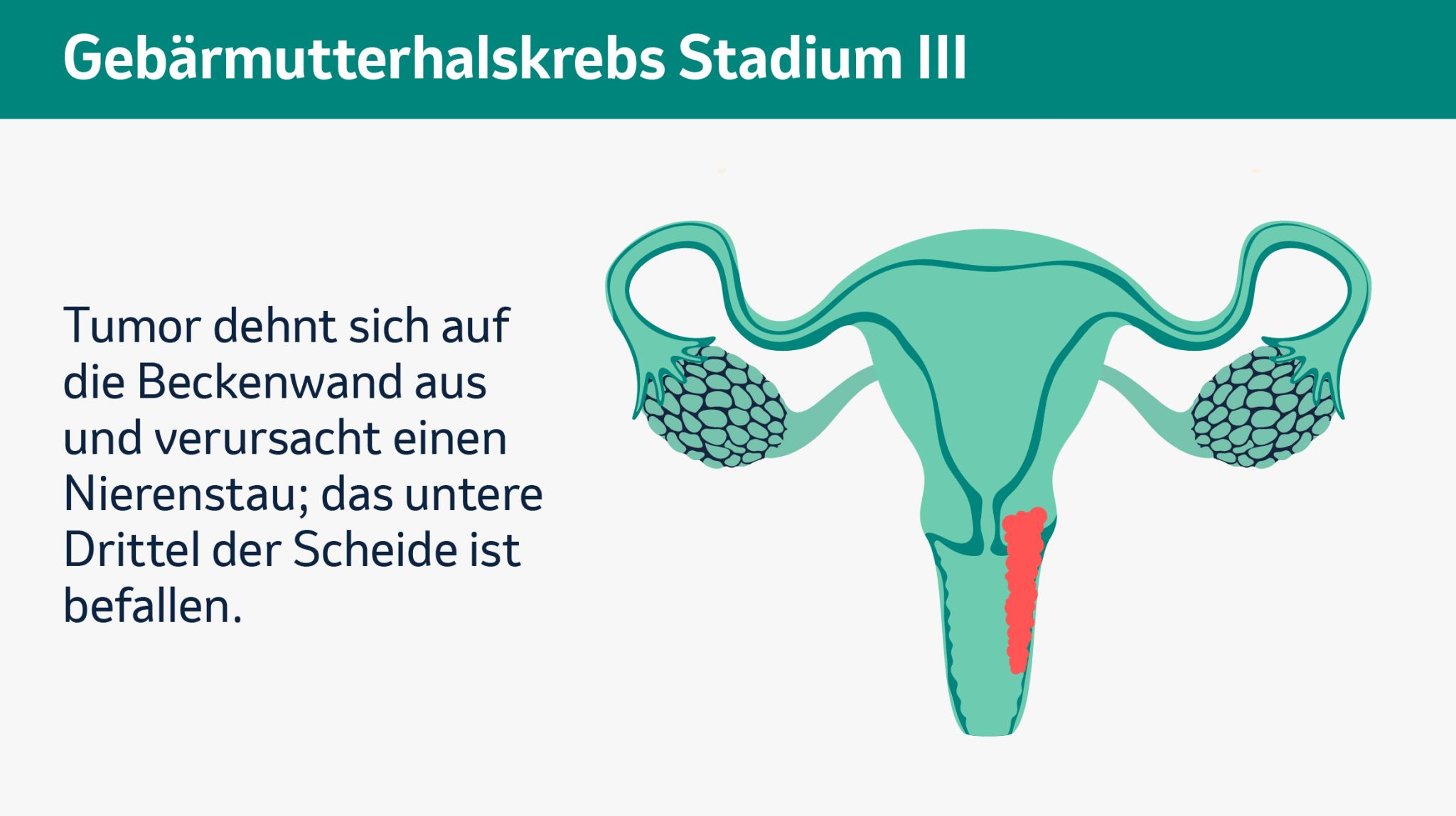 Schematische Darstellung der Gebärmter mit Tumor, der bis zur Beckenwand reicht, einen Nierenstau verursacht und das untere Drittel der Scheide befällt (Stadium III).