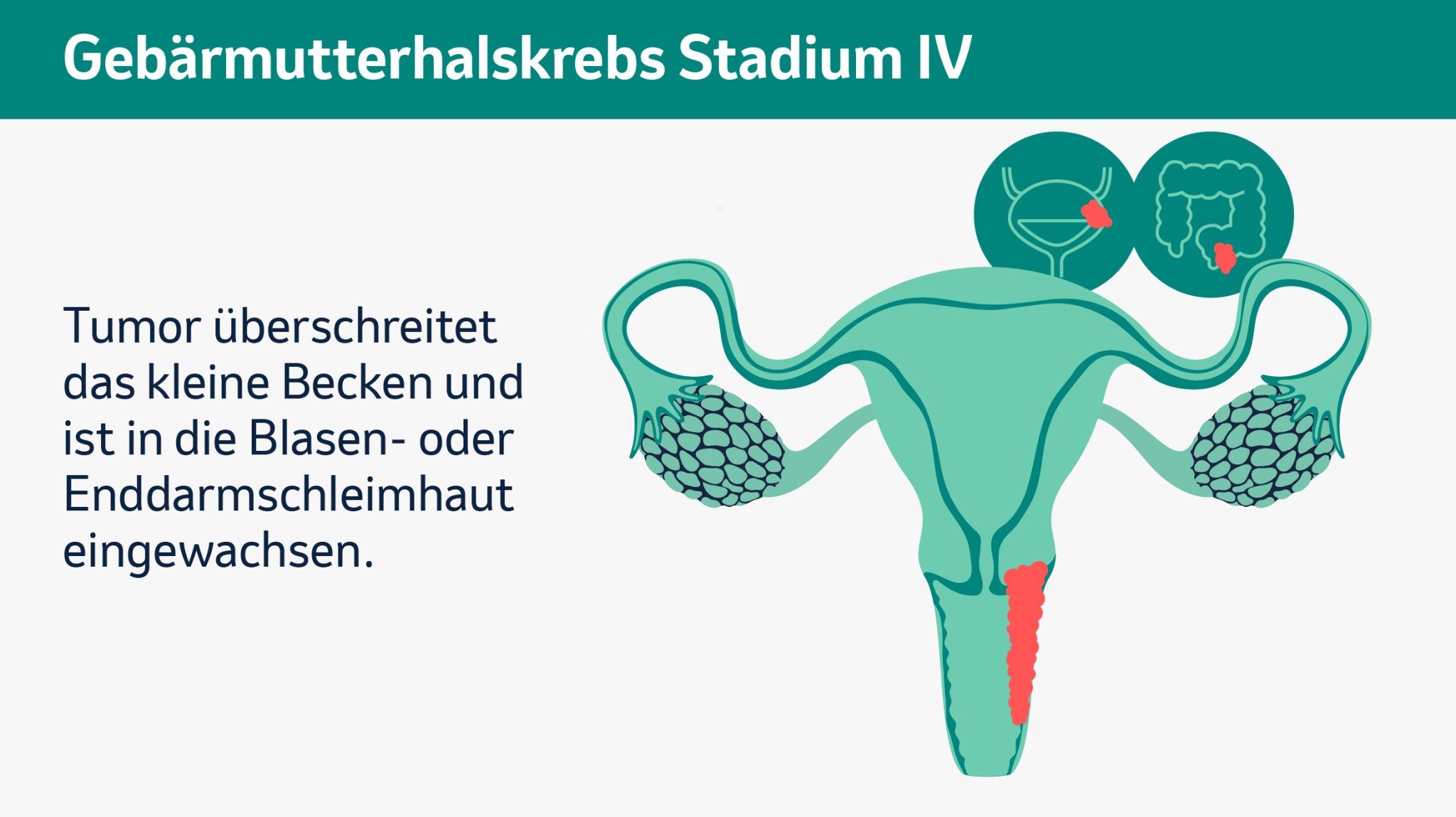 Schematische Darstellung der Gebärmutter mit fortgeschrittenem Tumor (Stadium IV), der über das kleine Becken hinaus in Blasen- oder Enddarmschleimhaut eingewachsen ist.