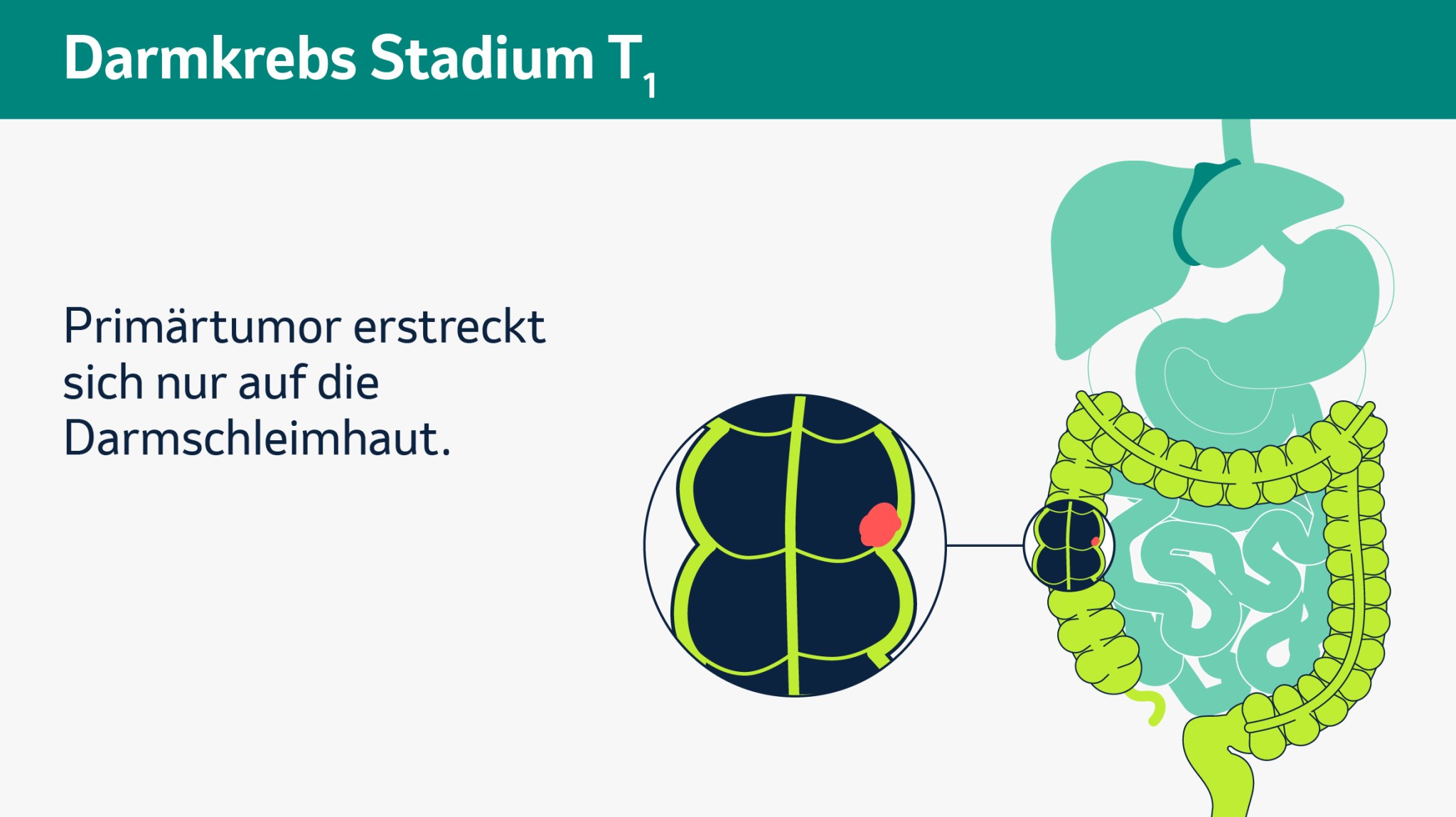 Infografik zum Darmkrebs-Stadium T1: Der Primärtumor beschränkt sich nur auf die Darmschleimhaut.