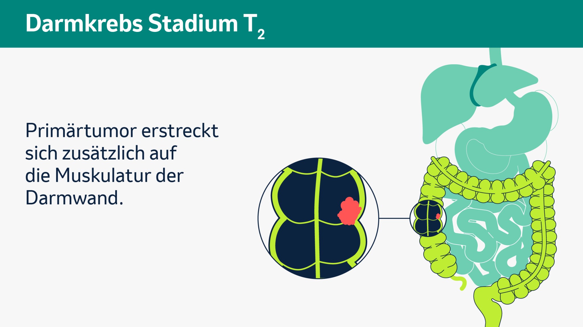 Infografik zum Darmkrebs-Stadium T2: Der Primärtumor breitet sich über die Darmschleimhaut hinaus bis in die Muskulatur der Darmwand aus.