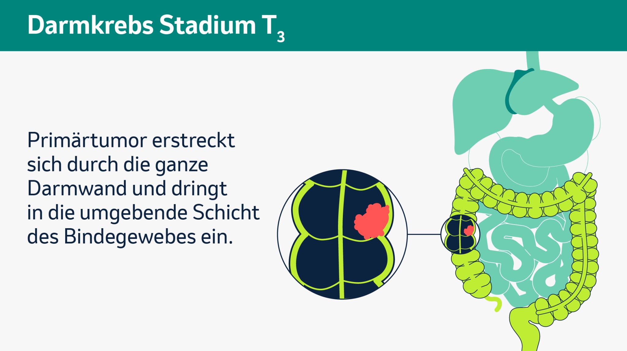 Infografik zum Darmkrebs-Stadium T3: Der Primärtumor hat sich durch die gesamte Darmwand ausgebreitet und dringt in das umliegende Bindegewebe ein.