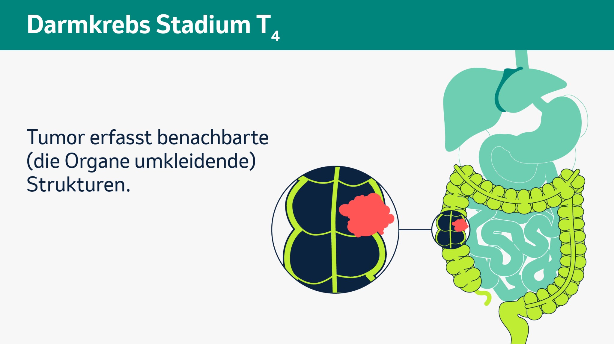 Infografik zum Darmkrebs-Stadium T4: Der Tumor hat die Darmwand vollständig durchdrungen und breitet sich auf benachbarte Strukturen oder Organe aus.