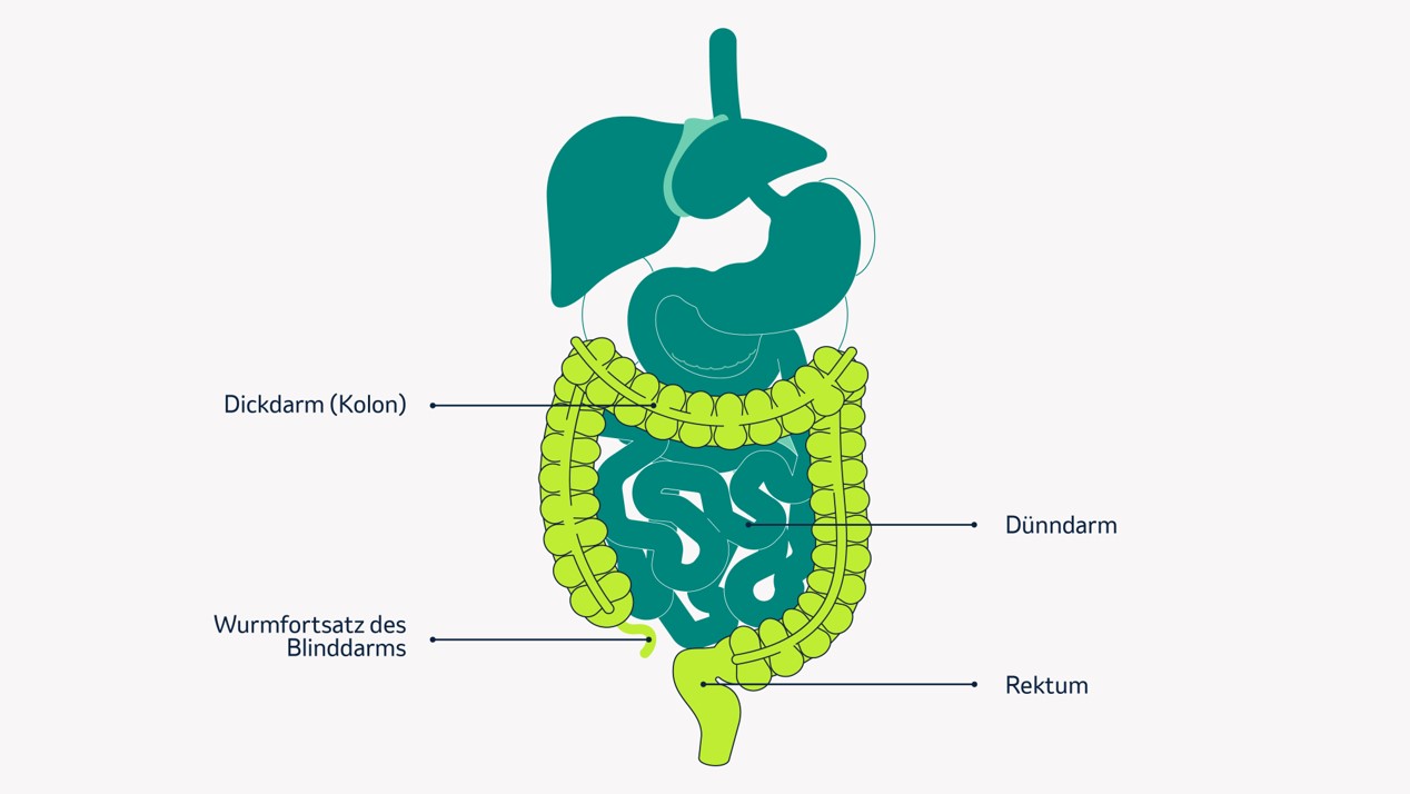 Schematische Darstellung des Verdauungstrakts mit farblich hervorgehobenen Bereichen: Dünndarm, Dickdarm (Kolon), Rektum sowie Wurmfortsatz des Blinddarms sind beschriftet.
