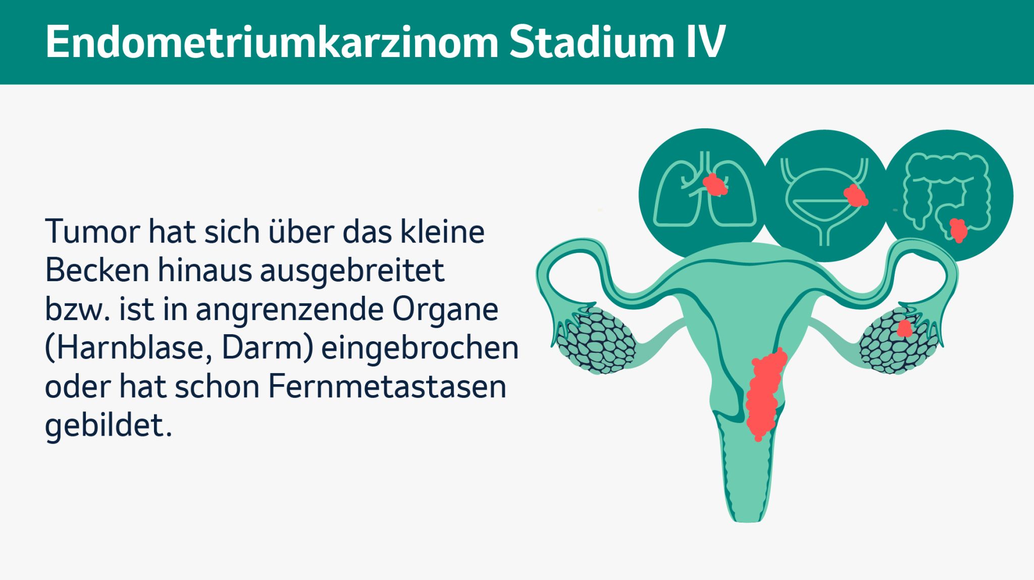 Endometriumkarzinom Stadium 4